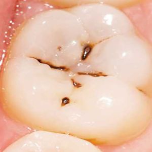 من هم الاشخاص المعرضون للاصابة بتسوس الاسنان؟